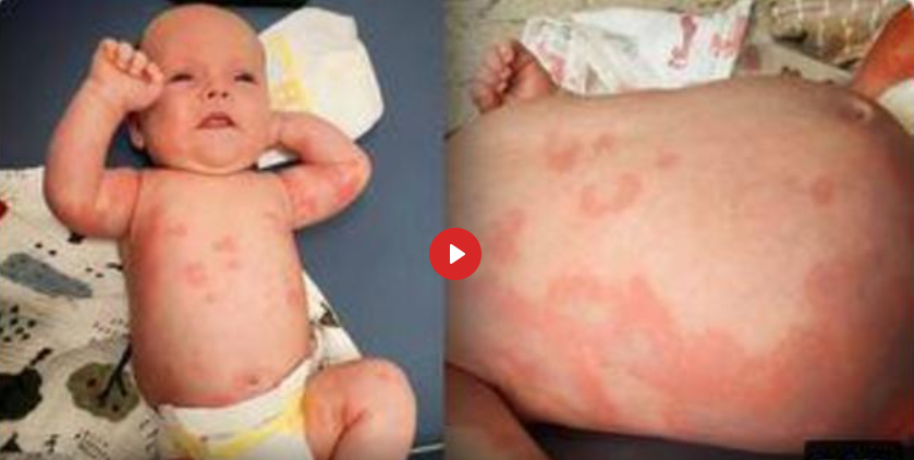 LE BÉBÉ A UNE RÉACTION AU V---A----X   DU LAIT MATERNEL DE LA MÈRE